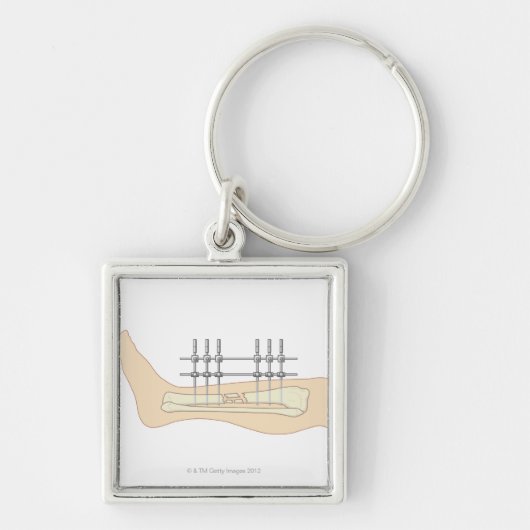 外的なFixator キーホルダー (正面)