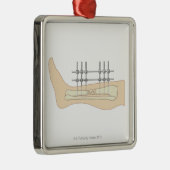 外的なFixator メタルオーナメント (右)