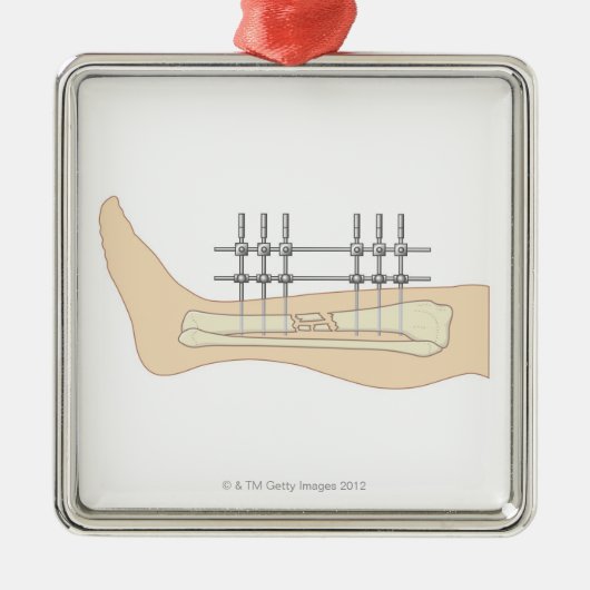 外的なFixator メタルオーナメント (正面)