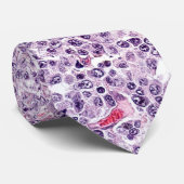 大細胞リンパ腫 ネクタイ (ロール)