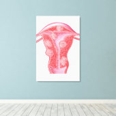 女性の子宮筋腫の解剖学 キャンバスプリント (インサイチュ (ウッドフロア))