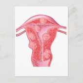 女性の子宮筋腫の解剖学 ポストカード (正面)