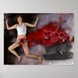 子宮摘出術 ポスター