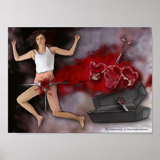 子宮摘出術 ポスター (正面)