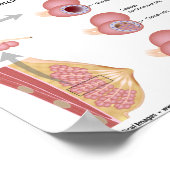小葉性乳がん、ラベル付き図。 ポスター (角)
