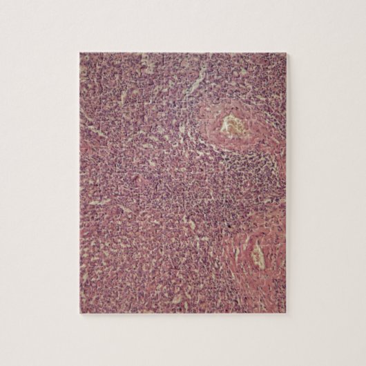 慢性のmyelogenous白血病の人間の脾臓 ジグソーパズル (縦)