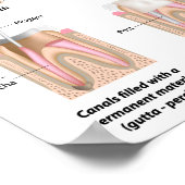 根管トリートメントポスター ポスター (角)