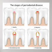 歯周病ポスター ポスター (正面)