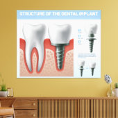 歯科用インプラントの構造 キャンバスプリント (インサイチュ (リビング))