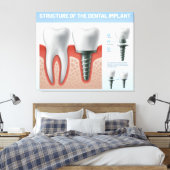 歯科用インプラントの構造 キャンバスプリント (インサイチュ (寝室))