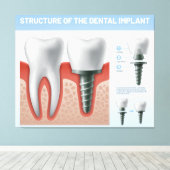 歯科用インプラントの構造 キャンバスプリント (インサイチュ (ウッドフロア))