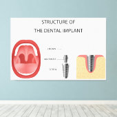 歯科用インプラント構造 キャンバスプリント (インサイチュ (ウッドフロア))