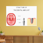 歯科用インプラント構造 キャンバスプリント (インサイチュ (リビング))
