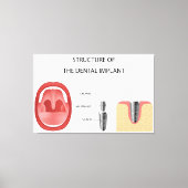 歯科用インプラント構造 キャンバスプリント (正面)