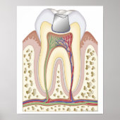 歯科用充填イラストレーション ポスター (正面)