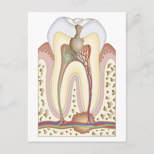 歯髄根膿瘍 ポストカード (正面)
