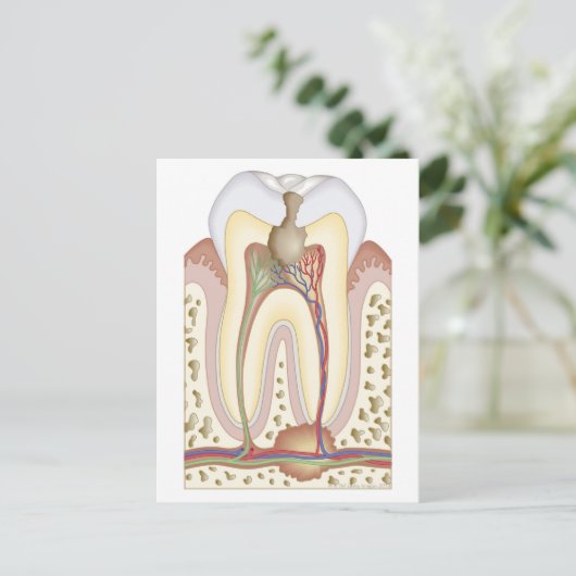 歯髄根膿瘍 ポストカード (スタンド正面)