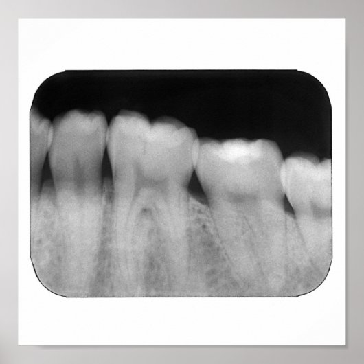 歯（充填） ポスター (正面)