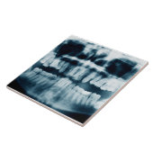 歯X線 タイル (側面)