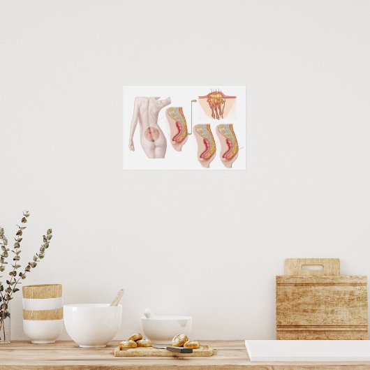 毛包嚢胞の医学的去勢 ポスター (キッチン)