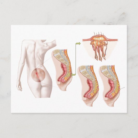 毛包嚢胞の医学的去勢 ポストカード (正面)