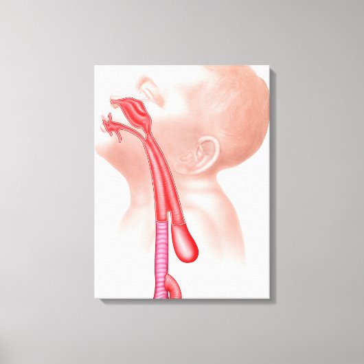 気管食道瘻構造 キャンバスプリント (正面)