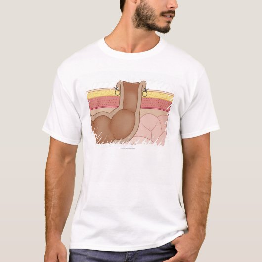 永久的なColostomy Tシャツ (正面)