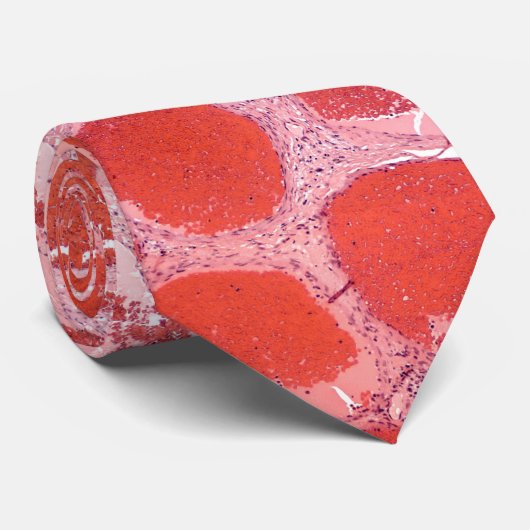 海綿状血管腫 ネクタイ (ロール)