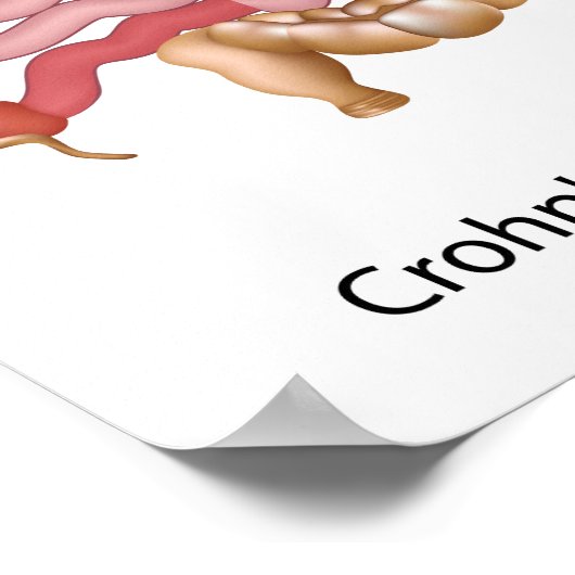 炎症性腸疾患のポスター ポスター (角)