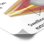 甲状腺眼病ポスター ポスター (角)