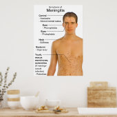 症状炎症性髄膜炎の表 ポスター (キッチン)