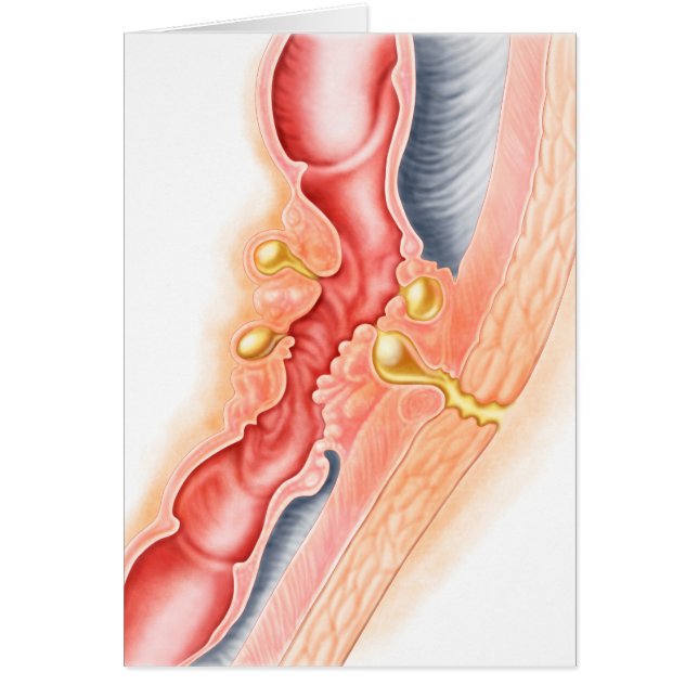 瘻孔の発達 (正面)