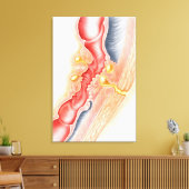 瘻孔の発達 キャンバスプリント (インサイチュ (リビング))