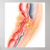 瘻孔の発達 ポスター (正面)