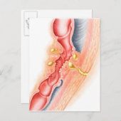 瘻孔の発達 ポストカード (正面/裏面)