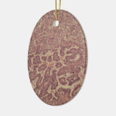 癌が付いている甲状腺の細胞 セラミックオーナメント (左)