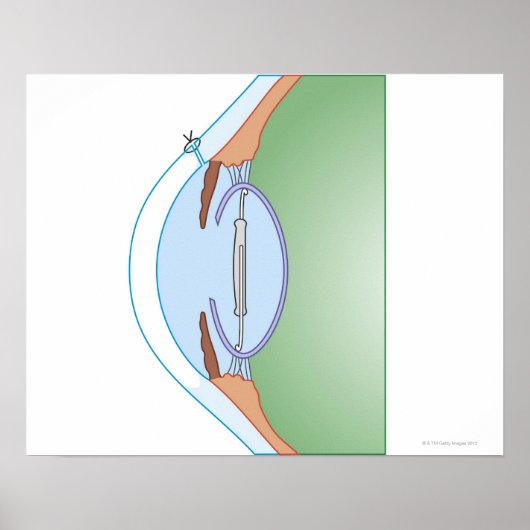 白内障手術 ポスター (正面)