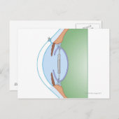 白内障手術 ポストカード (正面/裏面)