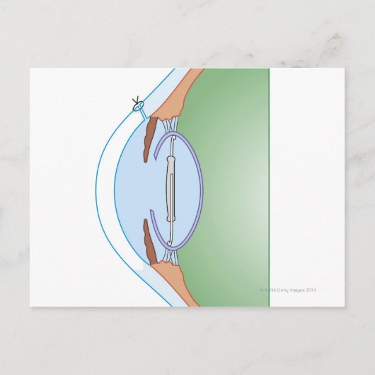 白内障手術 ポストカード (正面)