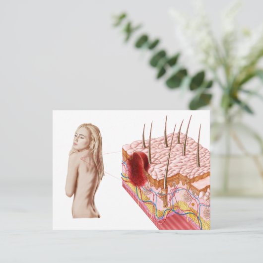 皮膚の非典型的な成長のイラスト ポストカード (スタンド正面)