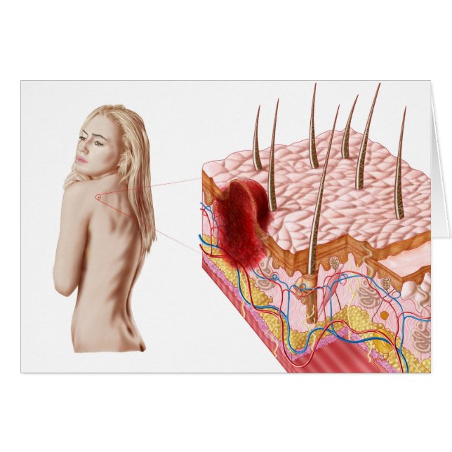 皮膚の非定型成長のイラストレーション (正面横)