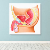 直腸尿道瘻孔の医学的イラストレーション キャンバスプリント (インサイチュ (ウッドフロア))