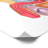 直腸尿道瘻孔の医学的イラストレーション ポスター (角)