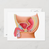 直腸尿道瘻孔の医学的イラストレーション ポストカード (正面/裏面)