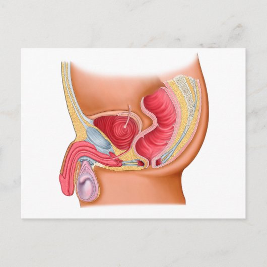 直腸尿道瘻孔の医学的イラストレーション ポストカード (正面)