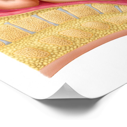 真空抽出を用いた胎児の分娩 ポスター (角)