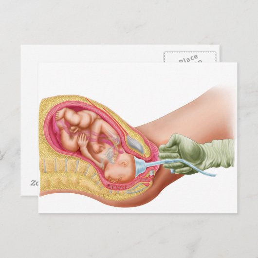 真空抽出を用いた胎児の分娩 ポストカード (正面/裏面)