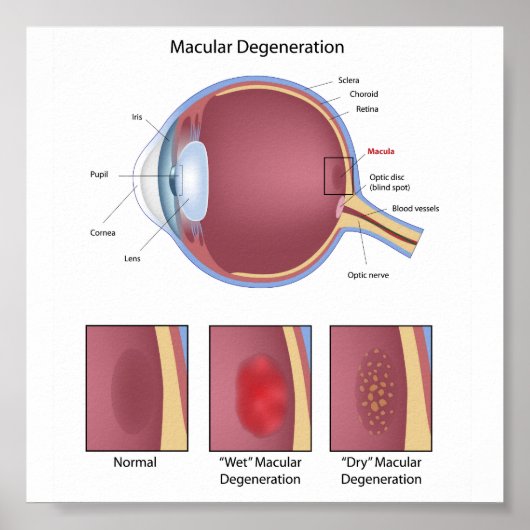 眼黄変性ポスター ポスター (正面)