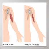 筋ジストロフィーのポスター ポスター (正面)