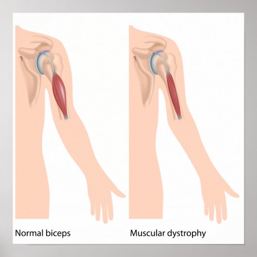 筋ジストロフィーのポスター ポスター (正面)